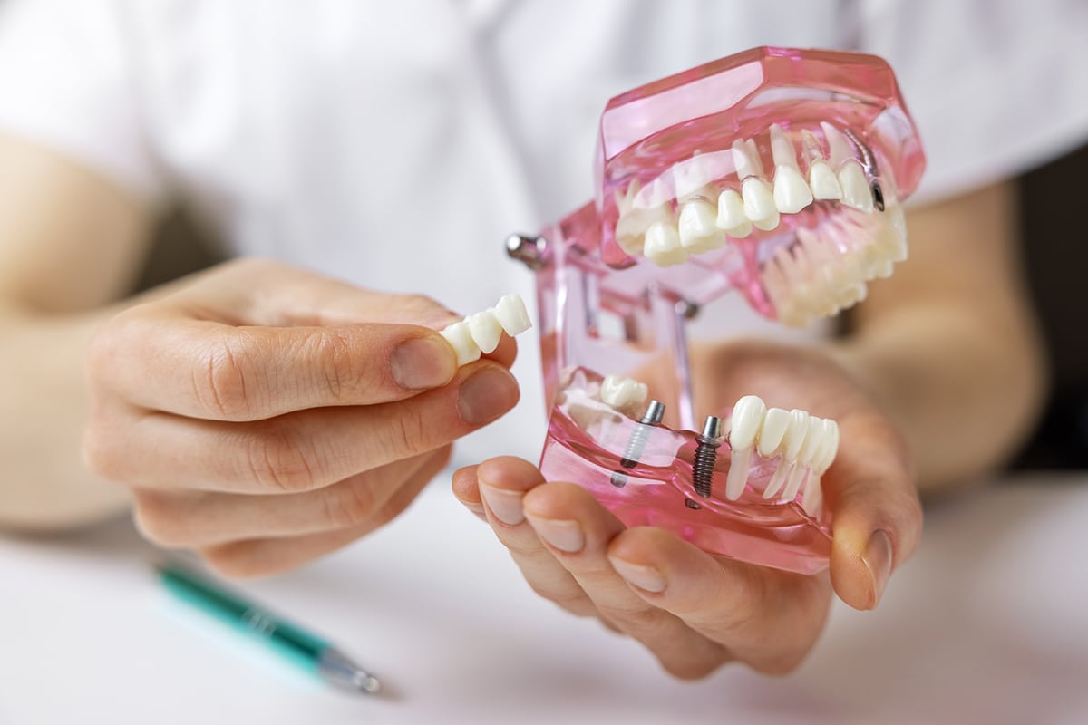 Dental bridges vs dental implants pros cons which ones right for you blog