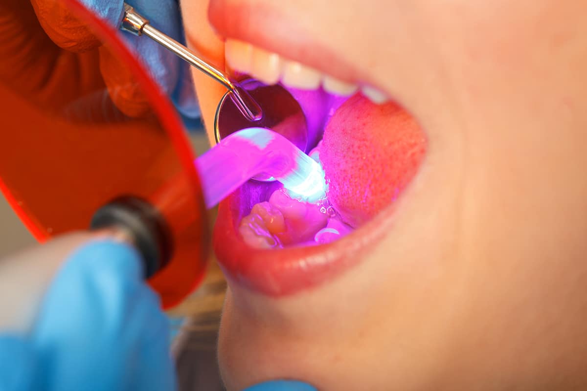 How long does dental bonding last blogjpg