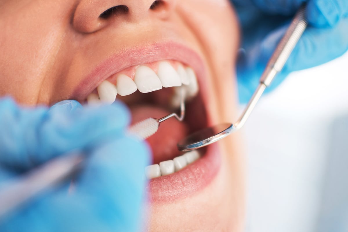 How long does professional teeth whitening last blog